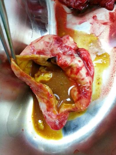 Figure 1: Intraoperative photograph of dissected giant appendicular abscess with brown faecolith and not the usual straw colored fluid content mimicking a caecal tumour and ceacal diverticulitis on clinical presentation and needle aspiration respectively.